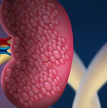 chronic-kidney-disease-and-what-you-need-to-know